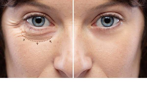 Important Aspects Of Best Blepharoplasty Surgeon