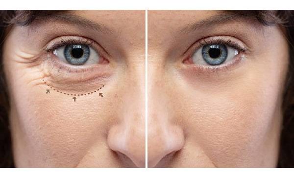 Important Aspects Of Best Blepharoplasty Surgeon